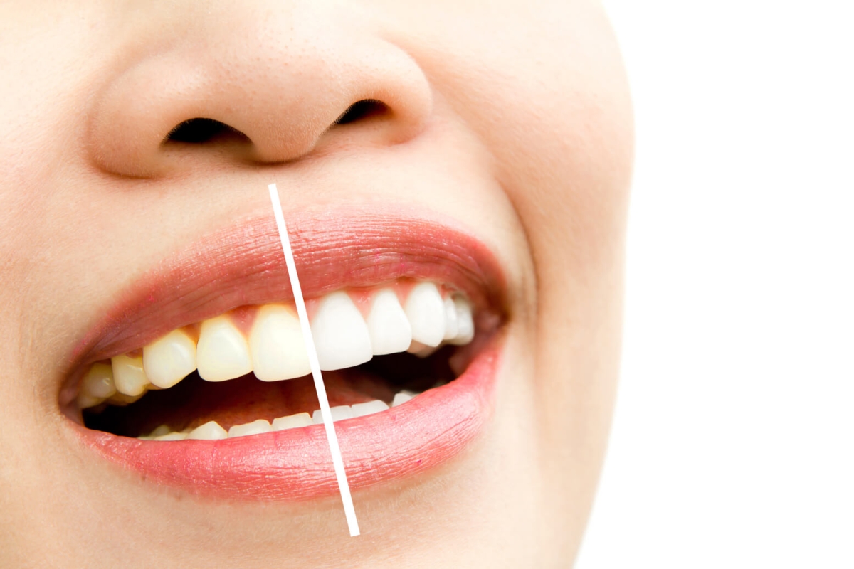 Evde dişleri beyazlatmak mümkün mü? İşte evde pratik 5 diş beyazlatma yöntemi